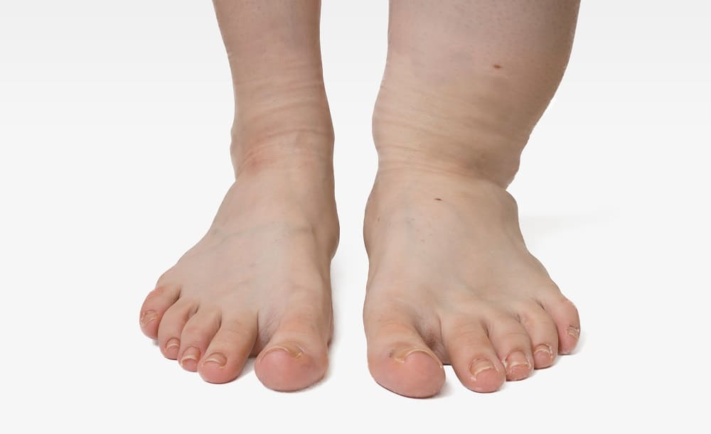 foot edema